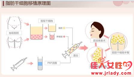 瘦的人還可以用自體脂肪豐胸嗎?