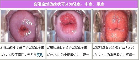 被宮頸糜爛糾纏不休 該怎麼治療宮頸糜爛?