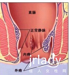 痔瘡便血的最佳治療方法